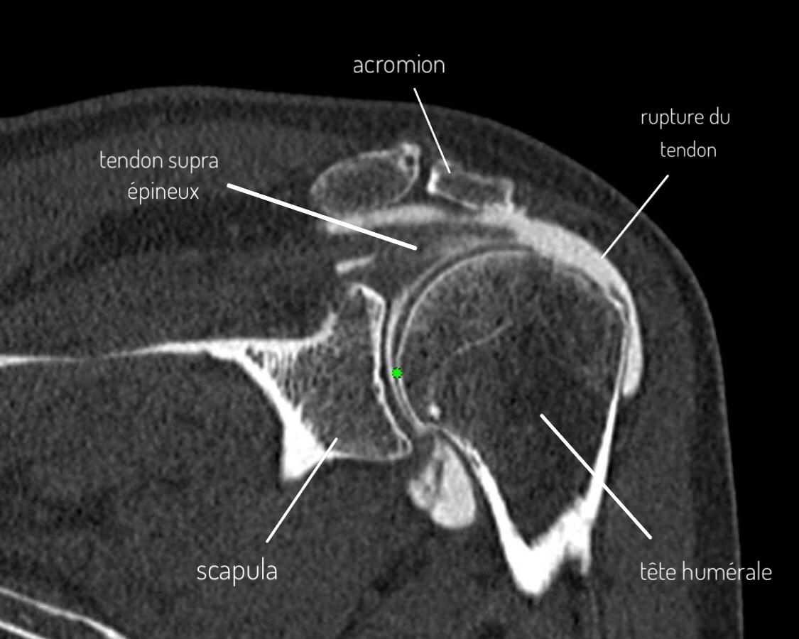 Arthro-CT showing supraspinatus tendon rupture