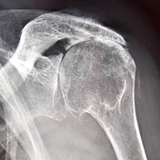Radiographie d'une arthrose de l'épaule excentrée
