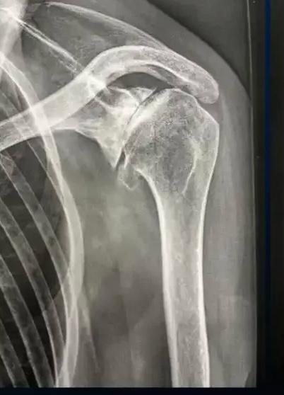 Radiographie de l'arthrose de l'épaule